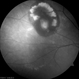 Extra Macular CNV Extra Macular CNV